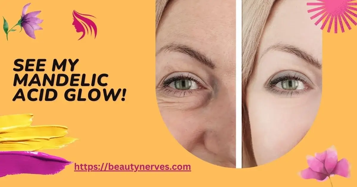 Mandelic Acid Before & After